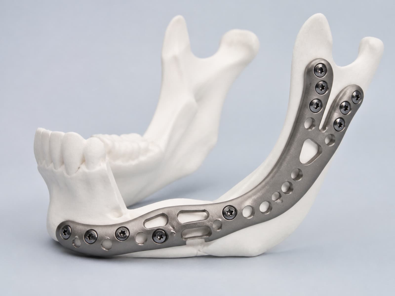 Placa de titanio a medida sobre un modelo de mandíbula impreso en 3D